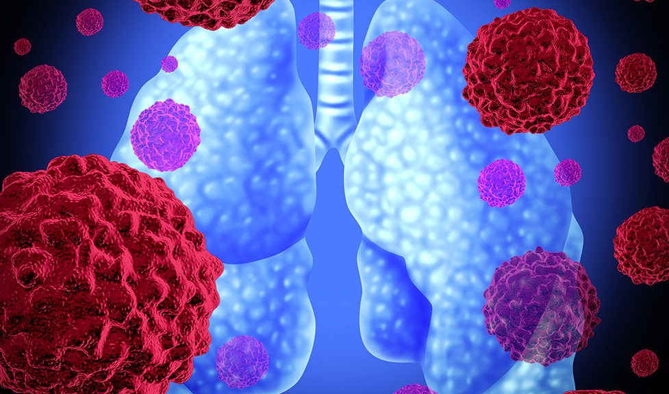 Firma Roche poinformowała, iż Komisja Europejska zatwierdziła lek trastuzumab emtanzyna do leczenia uzupełniającego chorych z HER2-dodatnim rakiem piersi po leczeniu neoadiuwatowym rak pluca 977x576 - Firma Roche poinformowała, iż Komisja Europejska zatwierdziła lek trastuzumab emtanzyna do leczenia uzupełniającego chorych z HER2-dodatnim rakiem piersi po leczeniu neoadiuwatowym