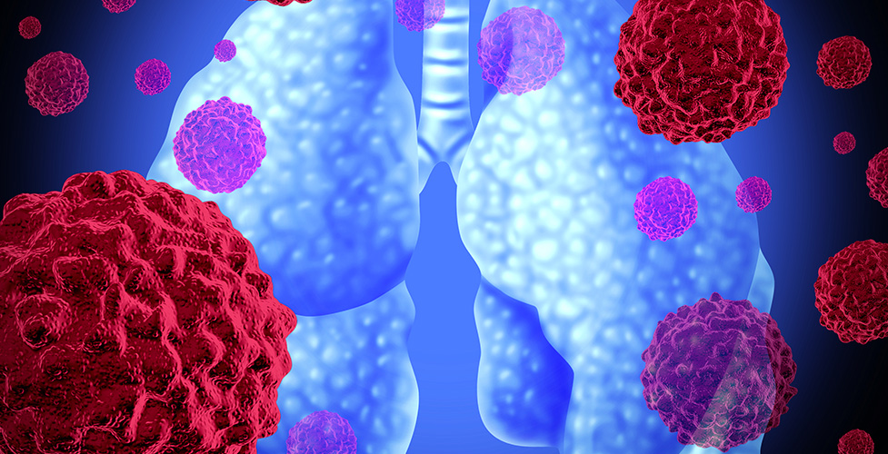 rak pluca1 - Firma Roche poinformowała, iż Komisja Europejska zatwierdziła lek trastuzumab emtanzyna do leczenia uzupełniającego chorych z HER2-dodatnim rakiem piersi po leczeniu neoadiuwatowym